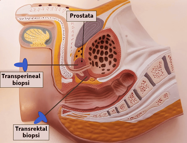 transperineal-biopsi